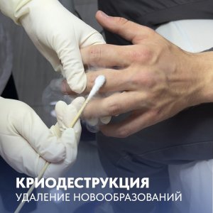 Удаление бородавок при помощи криодеструкции (жидкий азот) — быстро и безопасно!