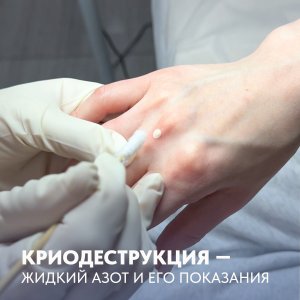 Показания к криодеструкции