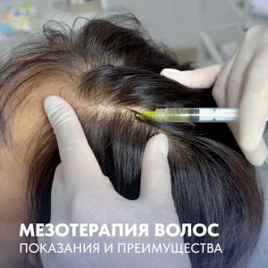 Мезотерапия волос: показания и преимущества