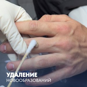 Удаление новообразований методом криодеструкции