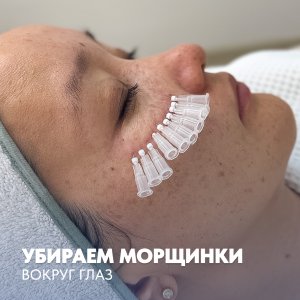 Убираем морщинки вокруг глаз с помощью точечных микронитей “POINT”